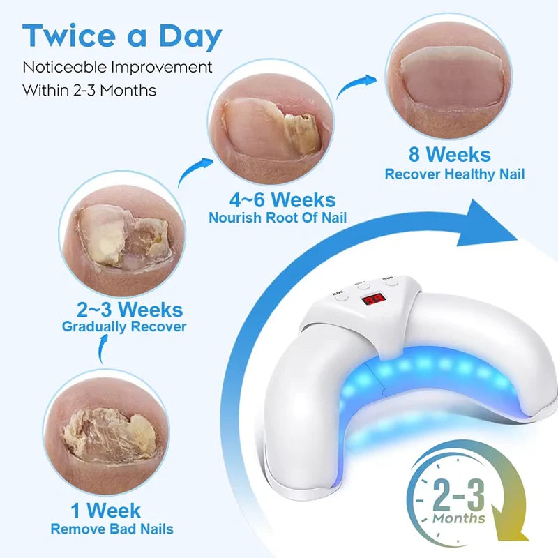Advanced Nail Fungus Treatment & Repair Device – Home Solution for Fingernails & Toenails
